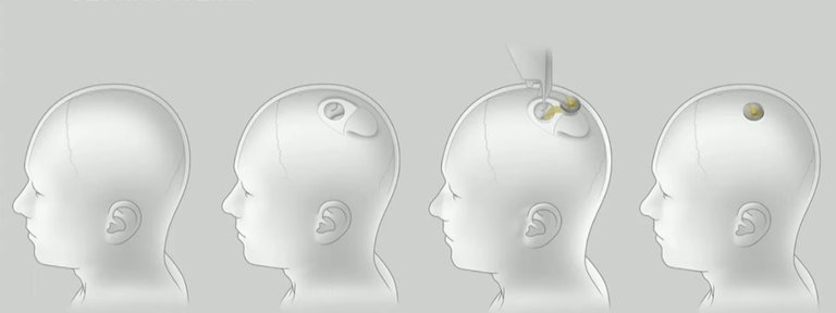 Neuralink: Elon Musk presentó su plan para implantar chips en el cerebro