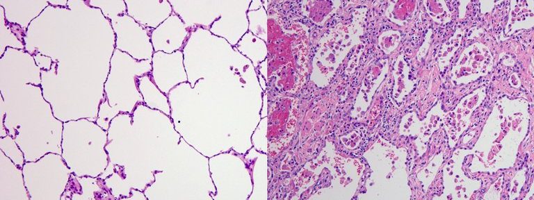 Científicos argentinos identifican 70 genes de células pulmonares que se verían afectados durante la infección por COVID-19