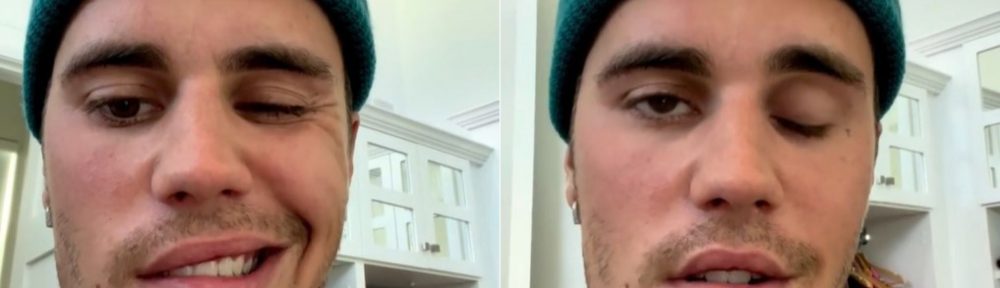 Justin Bieber confesó que sufre de parálisis en la mitad del rostro por un virus: “Es muy grave”